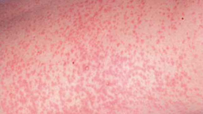 Measles